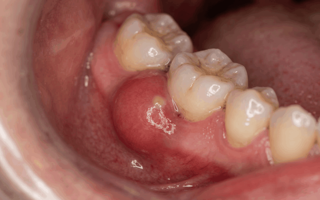 ¿Absceso periodontal o “flemón de encía”?: por qué algunas infecciones de encías aparecen de golpe y cómo pueden poner en riesgo dientes aparentemente salvables