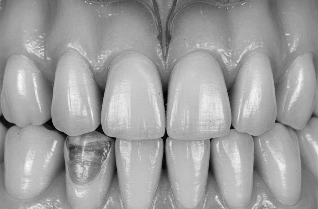 ¿Tienes dientes desgastados y no sabes por qué? La bruxofaceta, el bruxismo y la pérdida de altura dental