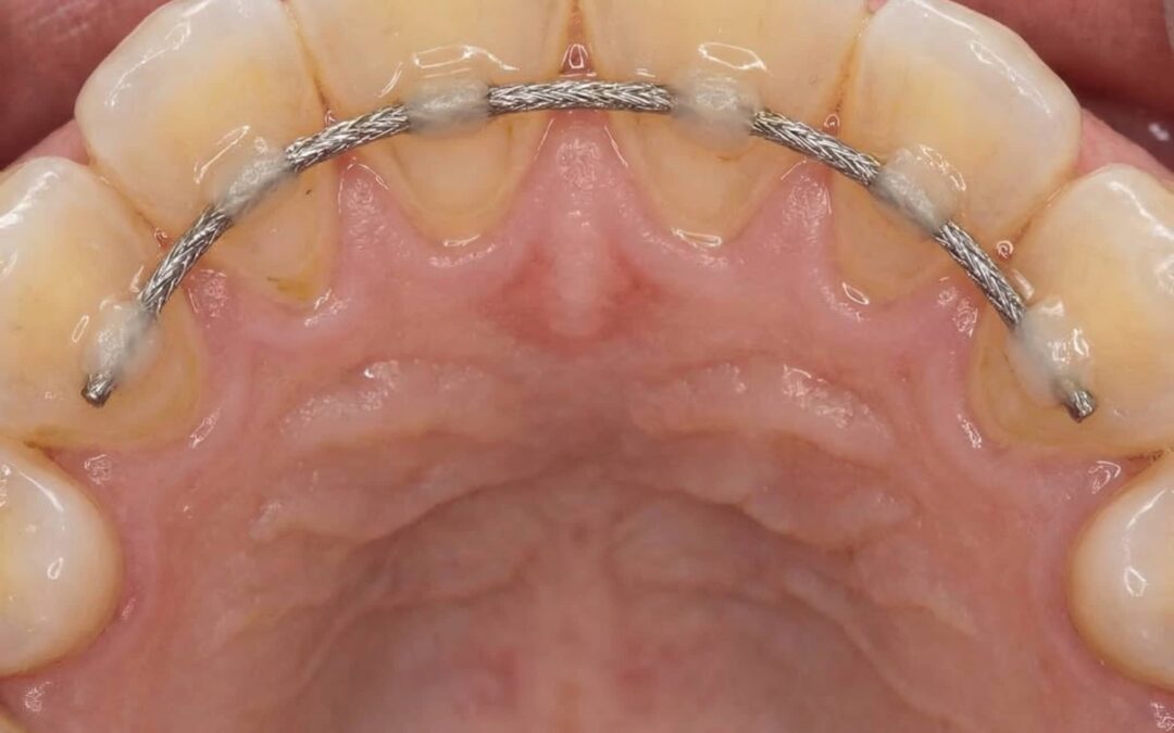 ¿Dientes que se mueven por periodontitis?: cuándo ferulizar puede ayudarte a conservar tu sonrisa